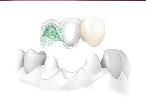 Cabinet dentaire prothèse sans métal
